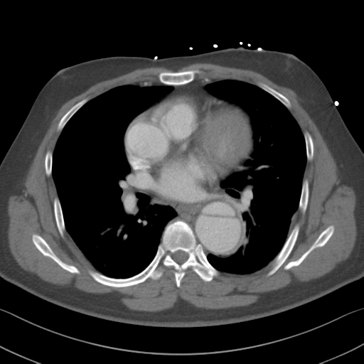 Aortic dissection (Radiopaedia 50763-56234 A 33).png