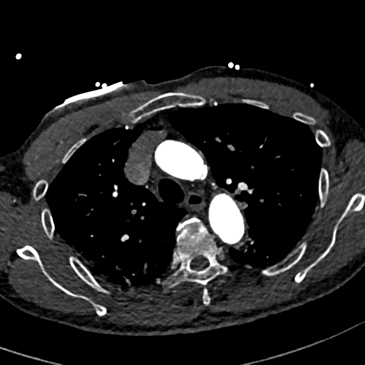 File:Aortic dissection - DeBakey type II (Radiopaedia 64302-73082 A 27).png