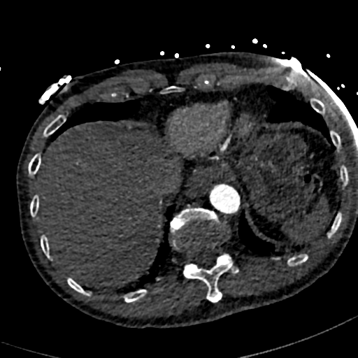 File:Aortic dissection - DeBakey type II (Radiopaedia 64302-73082 A 77).png