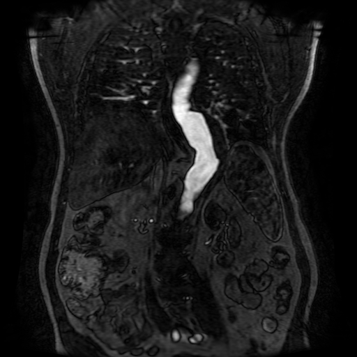 Aortic dissection - Stanford A - DeBakey I (Radiopaedia 23469-23551 D 157).jpg