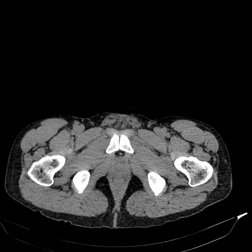 Aortic dissection - Stanford type A (Radiopaedia 83418-98500 Axial non-contrast 95).jpg