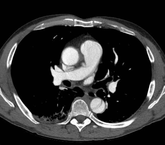 File:Aortic dissection - Stanford type B (Radiopaedia 73648-84437 A 50).jpg
