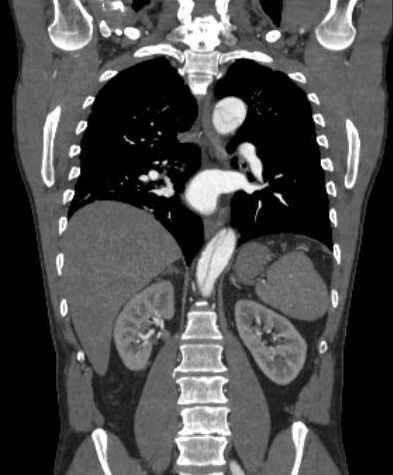 File:Aortic dissection - Stanford type B (Radiopaedia 73648-84437 B 75).jpg