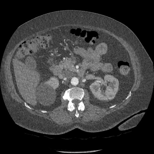 Aortic dissection - Stanford type B (Radiopaedia 88281-104910 A 114).jpg
