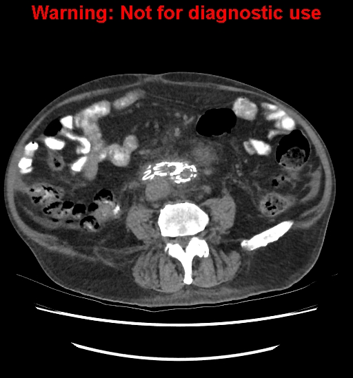 Aortic graft infection (Radiopaedia 44979-48907 Axial non-contrast 58).jpg