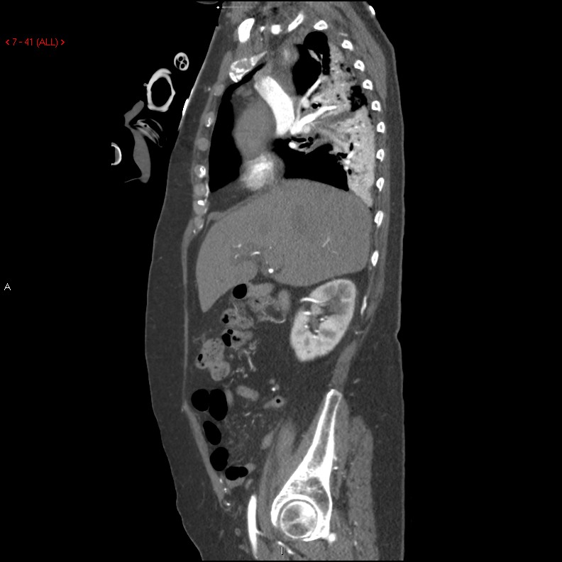 Aortic intramural hematoma (Radiopaedia 27746-28001 C 10).jpg