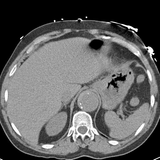 Aortic intramural hematoma (Radiopaedia 31139-31838 Axial non-contrast 48).jpg
