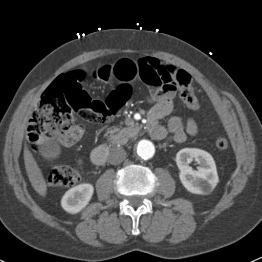 Aortic intramural hematoma (Radiopaedia 31139-31838 B 105).jpg