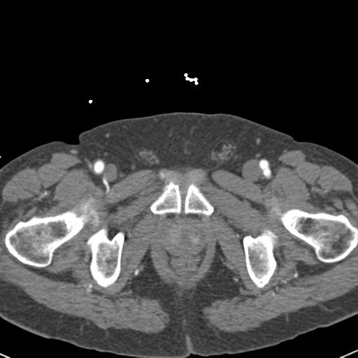 Aortic intramural hematoma (Radiopaedia 31139-31838 B 172).jpg