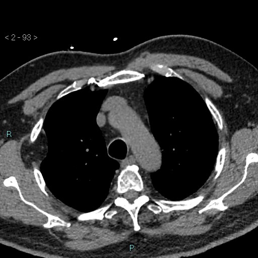 Aortic intramural hematoma (Radiopaedia 48463-53380 Axial non-contrast 41).jpg