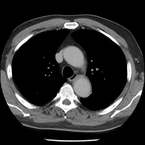 Aortic intramural hematoma (type B) (Radiopaedia 79323-92387 Axial C+ delayed 16).jpg