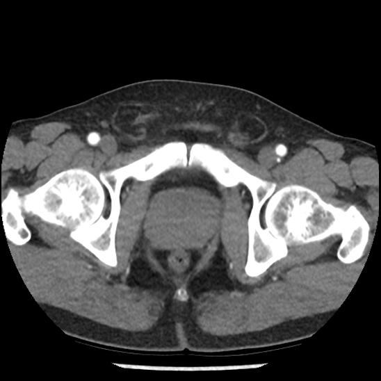 Aortic intramural hematoma (type B) (Radiopaedia 79323-92387 B 114).jpg