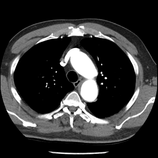 File:Aortic intramural hematoma (type B) (Radiopaedia 79323-92387 B 14).jpg