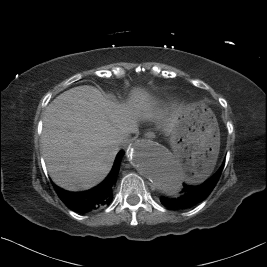 Aortic intramural hematoma with dissection and intramural blood pool (Radiopaedia 77373-89491 Axial non-contrast 81).jpg