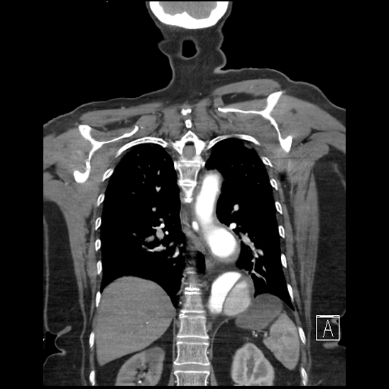 Aortic intramural hematoma with dissection and intramural blood pool (Radiopaedia 77373-89491 C 46).jpg