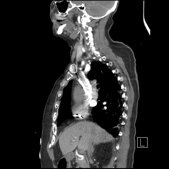 Aortic intramural hematoma with dissection and intramural blood pool (Radiopaedia 77373-89491 D 34).jpg