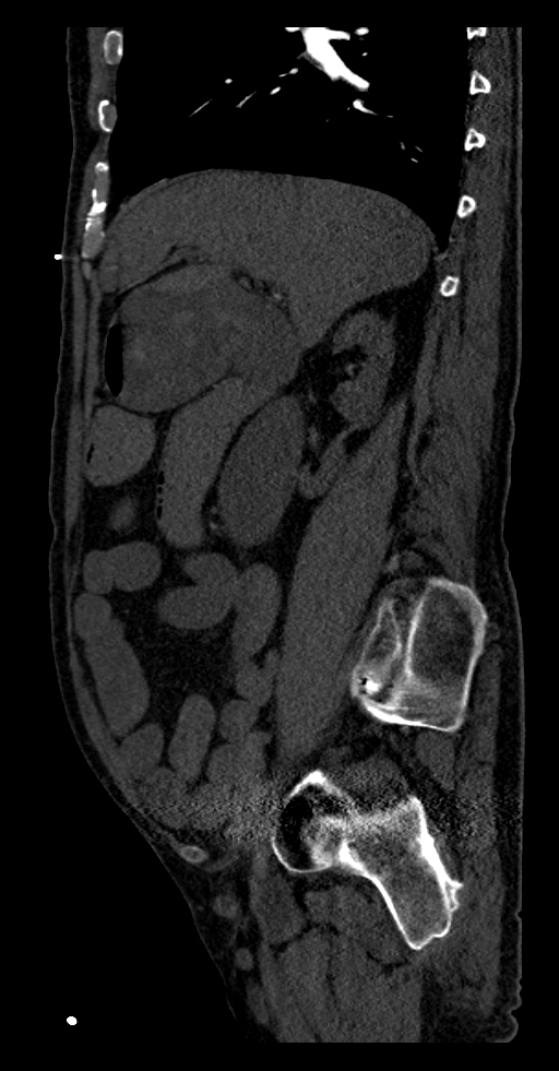 Aortoduodenal fistula (Radiopaedia 75286-86415 F 46).jpg