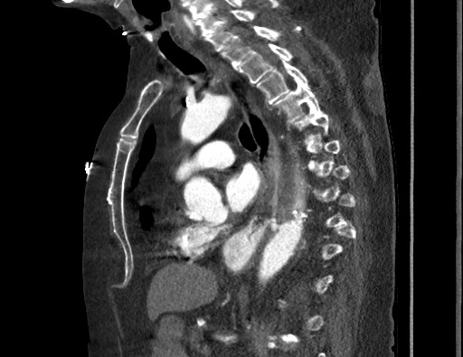 Aortoesophageal fistula with endovascular repair (Radiopaedia 73781-84592 Sagittal C+ CTPA 107).jpg
