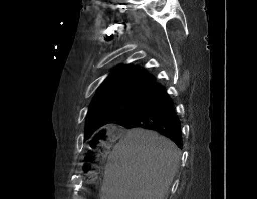 File:Aortoesophageal fistula with endovascular repair (Radiopaedia 73781-84592 Sagittal C+ CTPA 24).jpg
