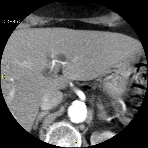 File:Aortoiliac occlusive disease (Radiopaedia 16828-16548 A 45).jpg
