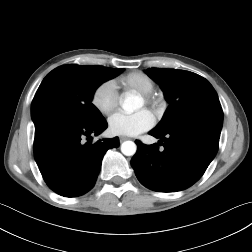 Apical pleural calcification (Radiopaedia 46141-50499 Axial C+ delayed 40).png