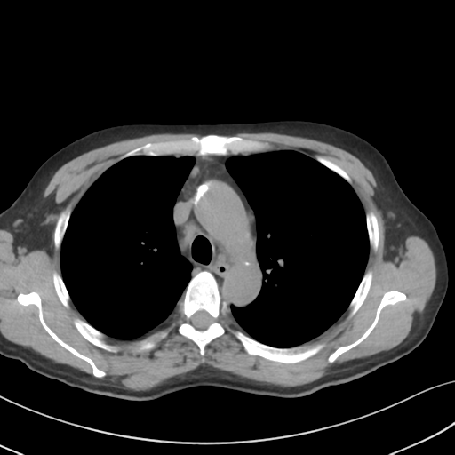 Apical pulmonary metastasis (Radiopaedia 46338-50754 B 22).png