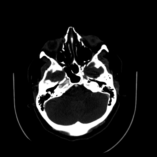 Aplasia of the internal carotid artery (Radiopaedia 61082-68960 A 17).jpg