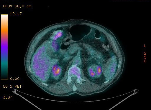 Appendiceal adenocarcinoma complicated by retroperitoneal abscess (Radiopaedia 58007-65041 Axial PET-CT 113).jpg