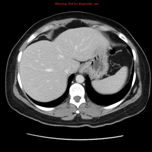 Appendiceal mucinous cystadenoma (Radiopaedia 8263-9111 Axial liver window 18).jpg