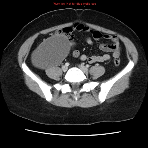 File:Appendiceal mucinous cystadenoma (Radiopaedia 8263-9111 Axial liver window 56).jpg