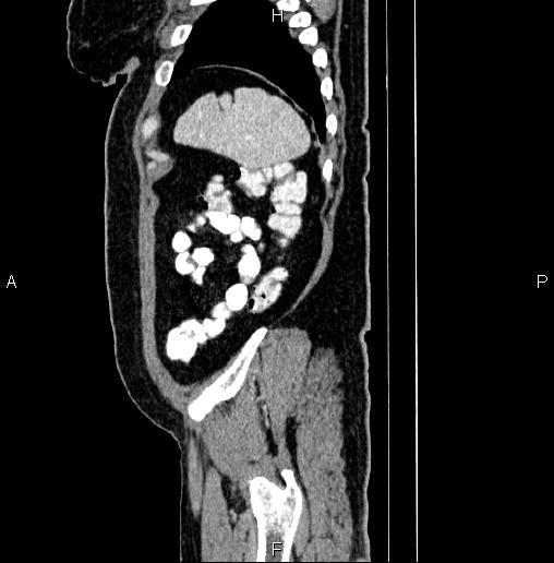 File:Appendiceal mucocele (Radiopaedia 82952-97298 D 99).jpg