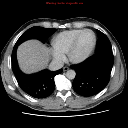 File:Appendicitis and renal cell carcinoma (Radiopaedia 17063-16760 A 3).jpg
