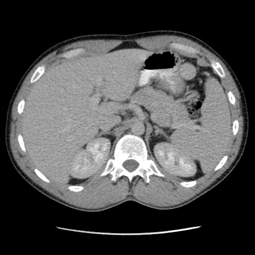 File:Appendicitis complicated by post-operative collection (Radiopaedia 35595-37113 A 16).jpg