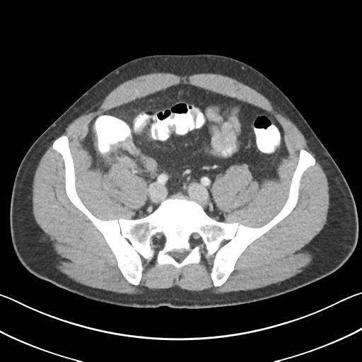 Appendicitis with cecal bar sign (Radiopaedia 31878-32830 B 59).jpg