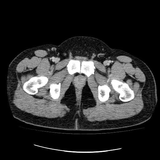 File:Appendicitis with diverticulosis (Radiopaedia 47693-52383 Axial C+ 147).jpg