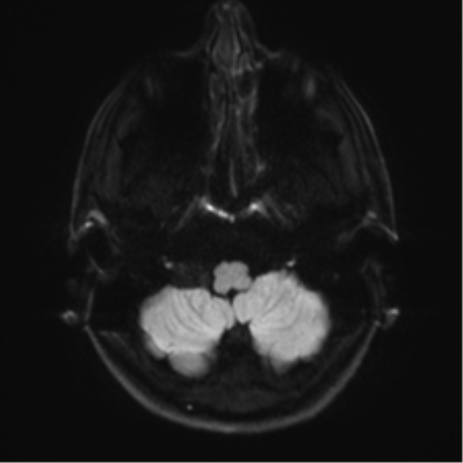 Arachnoid cyst - cerebellopontine angle (Radiopaedia 59689-67083 Axial DWI 41).png