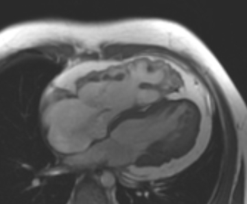 File:Arrhythmogenic right ventricular cardiomyopathy (Radiopaedia 69431-79307 4ch cine 28).jpg