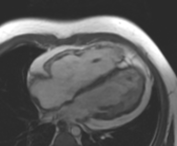 Arrhythmogenic right ventricular cardiomyopathy (Radiopaedia 69431-79307 4ch cine 59).jpg