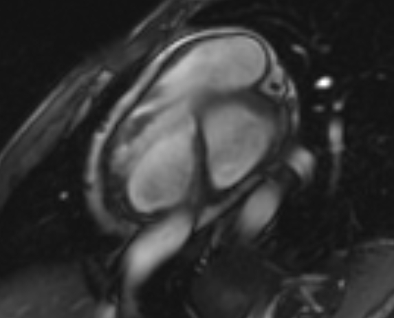 File:Arrhythmogenic right ventricular cardiomyopathy (Radiopaedia 69564-79464 short axis cine 252).jpg