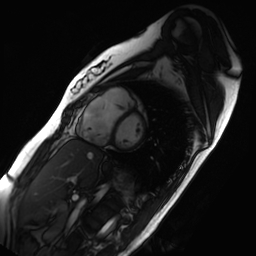 Arrhythmogenic right ventricular cardiomyopathy (Radiopaedia 87505-103850 short axis Cine SSFP 140).jpg