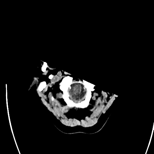 File:Arteriovenous malformation (cerebral) (Radiopaedia 40070-42579 Axial non-contrast 3).png