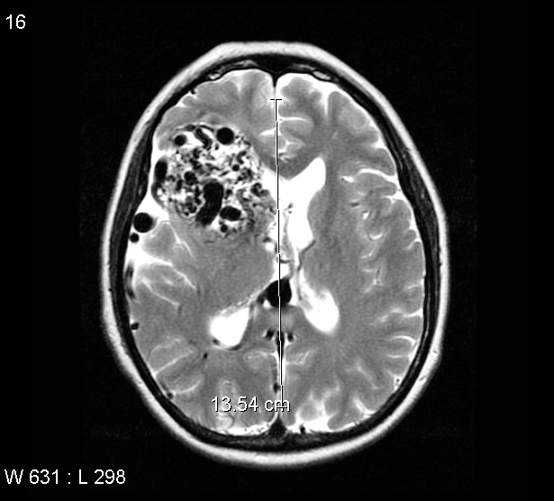 File:Arteriovenous malformation - cerebral (Radiopaedia 4000-6538 Axial T2 10).jpg