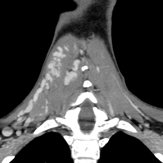 Arteriovenous malformation of the neck (Radiopaedia 53935-60062 D 38).jpg