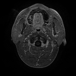 Artery of Percheron infarction (Radiopaedia 27975-28230 Axial T1 C+ fat sat 4).jpg