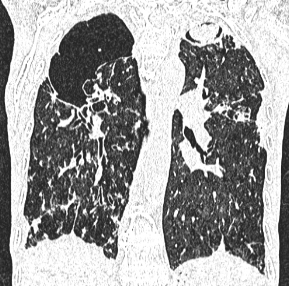 Aspergilloma- with Monod sign (Radiopaedia 44737-48532 Coronal lung window 294).jpg