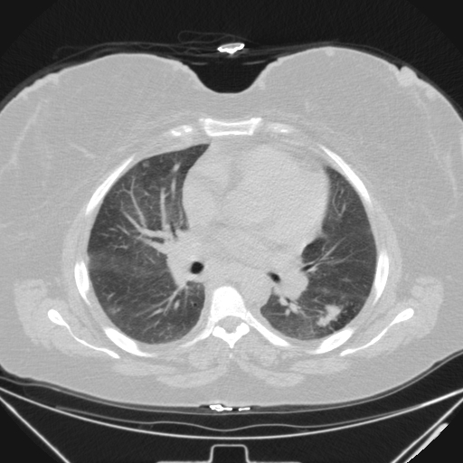 Aspergilloma (Radiopaedia 39611-41932 Axial lung window 63).jpg
