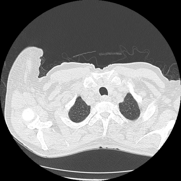 Aspergilloma (Radiopaedia 44592-48327 Axial lung window 1).jpg