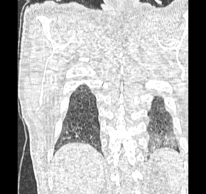 Aspergilloma (Radiopaedia 44592-48327 Coronal lung window 122).jpg