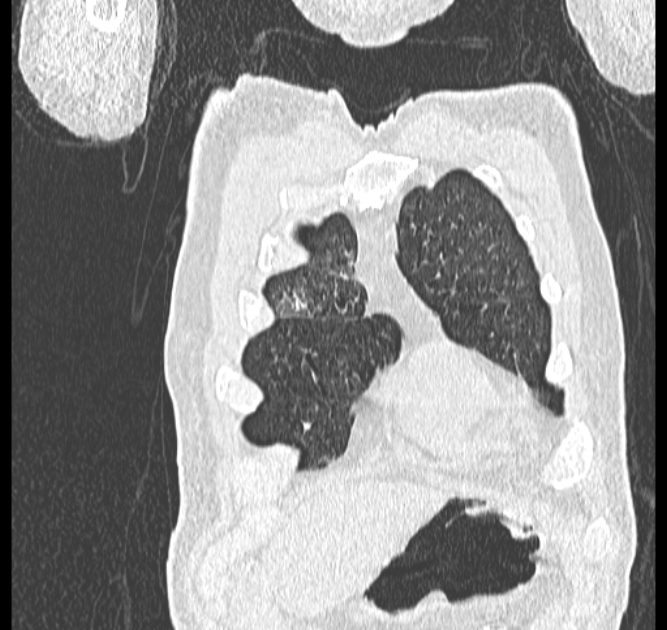 Aspergilloma (Radiopaedia 44592-48327 Coronal lung window 7).jpg