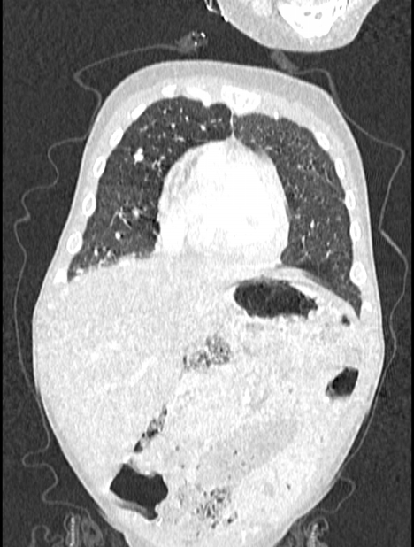 Asplenia syndrome (Radiopaedia 73083-83792 Coronal lung window 30).jpg